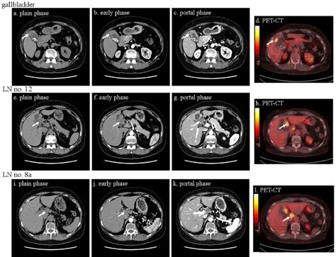 Dynamic Ct Scan And Pet Ct Scan Findings Of The Gallbladder The Figure