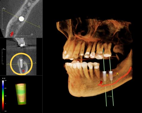 Dental Implant And Ct Scan A Dental Blog By Alex H Nguyen Dds