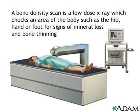 A bone density test is used to measure bone mineral content and density. Bone mineral density test. Causes, symptoms, treatment ...