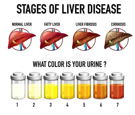 Stages Of Liver Damage From Healthy Fatty Liver Fibrosis Cirrhosis