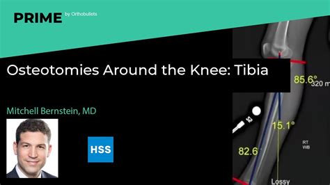 Osteotomies Around The Knee Tibia Mitchell Bernstein Md Youtube