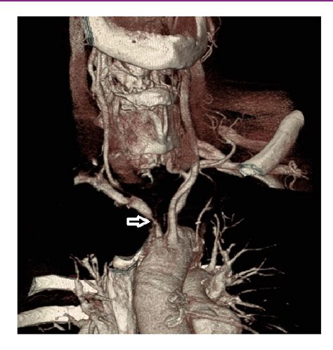 Figure 3 From Embolic Middle Cerebral Artery Occlusion From Innominate