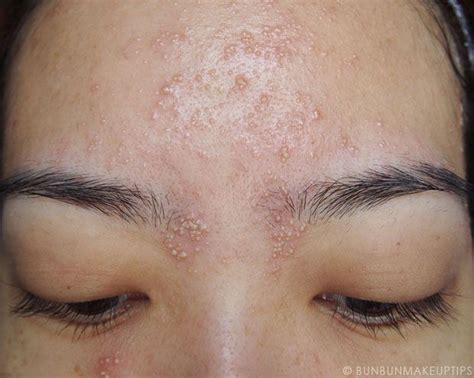 Hypoallergenic Makeup The Worst Thing Forehead