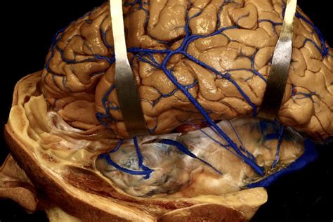 Superficial Venous Drainage of the Cerebrum | Neuroanatomy | The