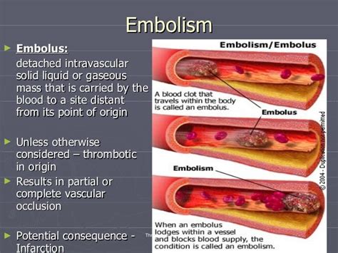 Thrombosis And Embolism