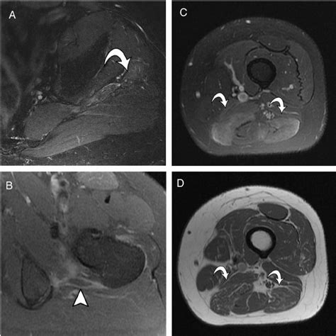 Axial Spair A And T1 Weighted Fat Suppressed Post Contrast B