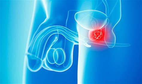 Symptoms of prostate cancer can include urinary frequency, urgency, and the need to urinate at night, as well as less common signs such as back pain. Prostate cancer symptoms: Back pain could be sign of ...