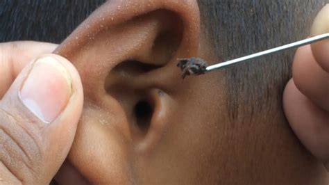 Removing Ear Wax