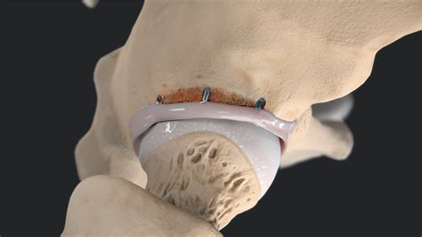 Arthrex Hip Labral Reconstruction
