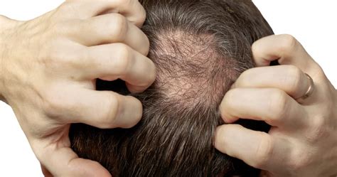 Ο θυρεοειδής μπορεί να επηρεάσει την υγεία των μαλλιών Pronews gr