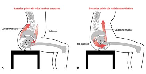 Introduction to musculoskeletal pathologies of the low back and pelvis. Let's Bands™ - Blog - Pelvic tilt, hollow back and back pain