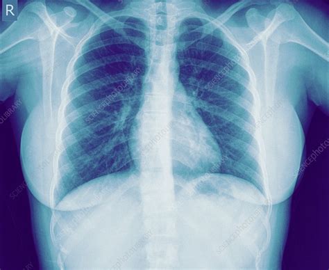 Normal Healthy Chest X Ray Stock Image C0197307
