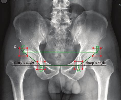 Sharps Angles Black Lines On A Pelvic X Ray Image Key Point A