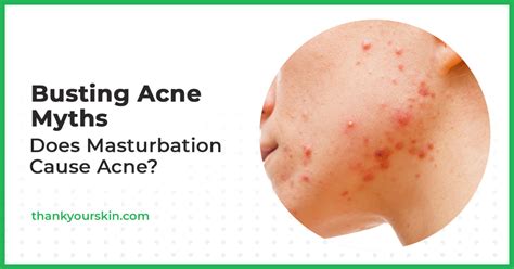 Does Masturbation Cause Acne