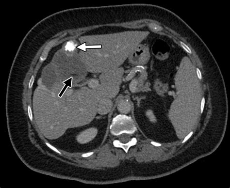 Case 275 Multiple Hepatic Hydatid Cysts Radiology