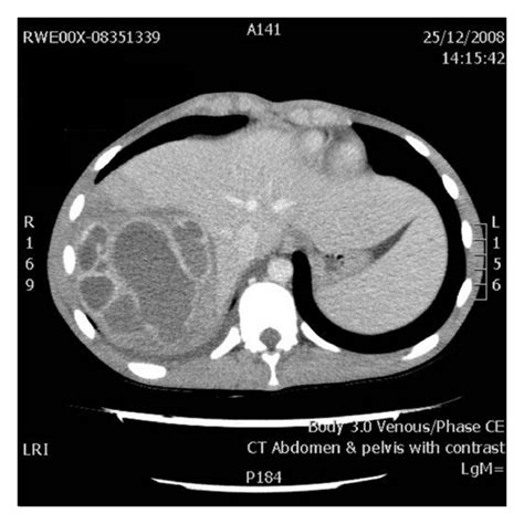 Ct Scan Demonstrating Multiloculated Liver Abscess Containing At Least