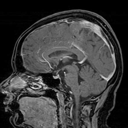 Superior Sagittal Sinus Thrombosis Radiology Reference Article