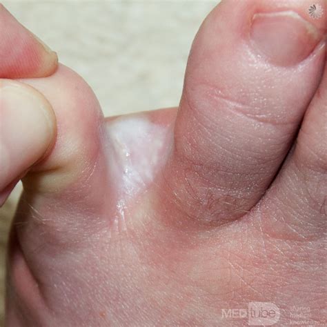 Dr Pelto S Blog Why Do I Get Athlete S Foot When I Am Far From Being
