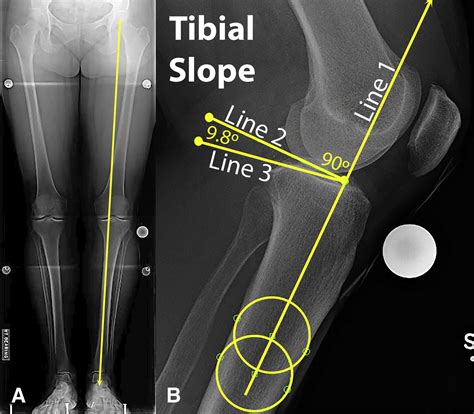 Medial Opening Wedge Proximal Tibial Osteotomy Arthroscopy Techniques