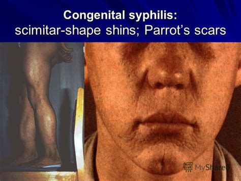 Congenital syphilis is syphilis present in utero and at birth, and occurs when a child is born to a mother with syphilis. Презентация на тему: "Syphilis Background Treponema ...
