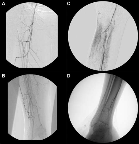Preoperative Right Lower Extremity Rle Angiograms A Groin B