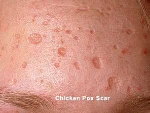Chickenpox used to be common in kids, causing a very itchy red rash all over the body. Schada Beauty & SPA: Rawatan untuk menghilangkan parut ...