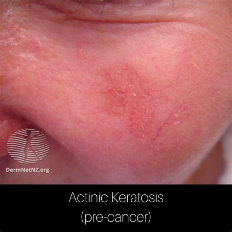 Spot On My Skin Actinic Keratosis Pre Cancer Derm Of The North