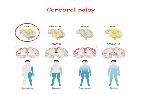 Cerebral Palsy Causes Symptom And Treatment