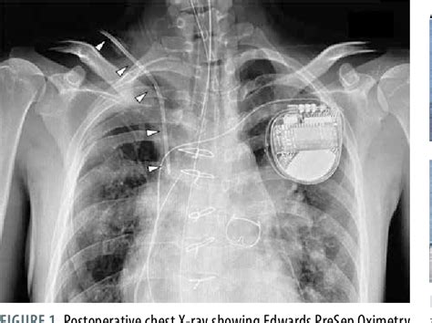 Figure 1 From Precautions With Right Supraclavicular Approach And