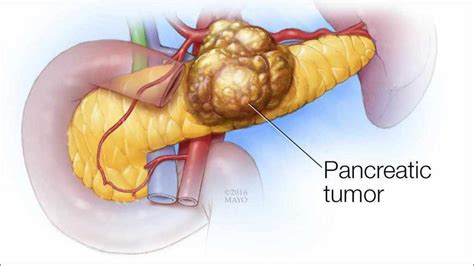 When the pancreas is diseased or inflamed, amylase releases into the blood. لماذا سرطان البنكرياس يعد الأشد فتكا - المرسال