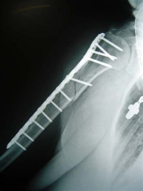 These guidelines have been produced to guide clinical decision making for the ice the affected limb. HUMERUS FRACTURE | GEORGE D. GOUDELIS MD. Ph.D.