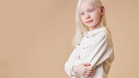 Albinizm Przyczyny Odmiany Metody Leczenia Wylecz To