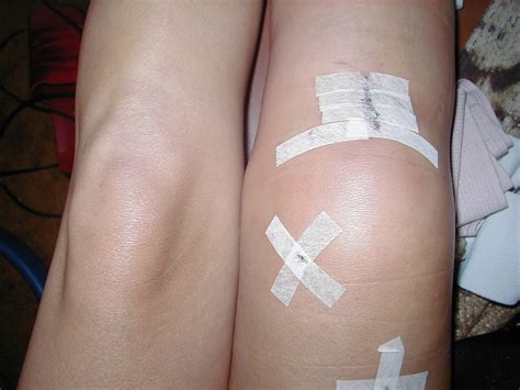 For the first 24 hours after surgery you should not be left alone. Knee Surgery to Repair the Meniscus Show High Failure Rate