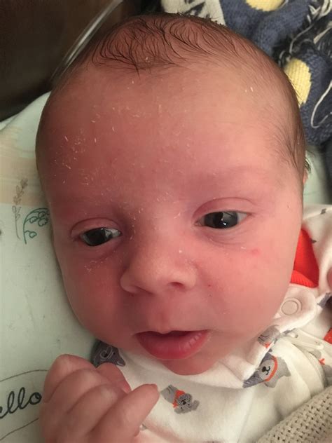 Baby Has Dry Skin — The Bump