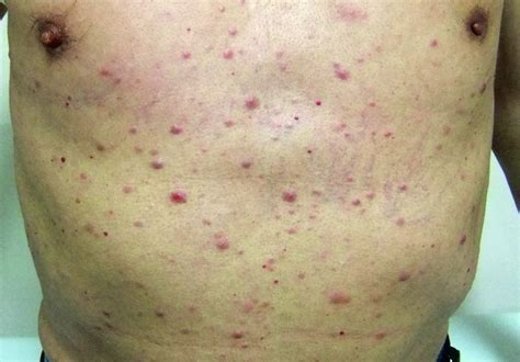 Check spelling or type a new query. Leucemia mieloide aguda (LMA) - Trastornos de la sangre ...