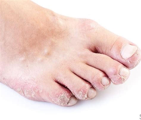 Foot Rash Causes Symptoms Home Remedies And Treatment Pictures