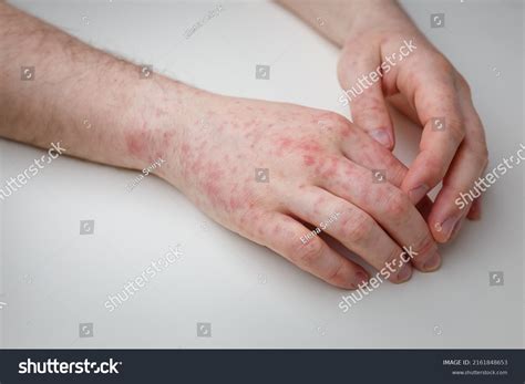 Allergy Red Itchy Rash On Male Stock Photo 2161848653 Shutterstock