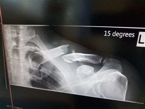 How I Broke My Collarbone Surgery And Recovery