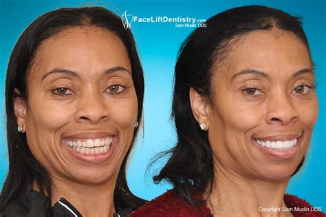 The person may want to fix their underbite solely for this reason. Before and After Photos: Underbite, Overbite, Open Bite