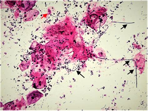 Microscopic Images Of Vaginal Smears After Gram Staining A Normal