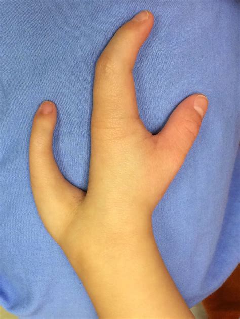 Ulnar Sided Cleft Hand Congenital Hand And Arm Differences Washington University In St Louis