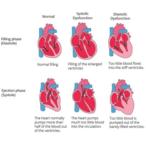 Cardiac Insufficiency Heart Failure Cardiosecur