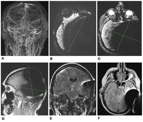 3d 15 T Mri Angiography A Diffusion Sequence B And T2 Flash