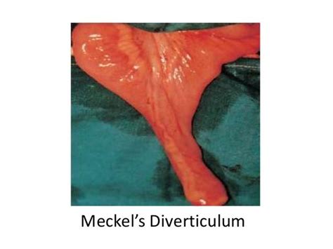Mekels Diverticulum