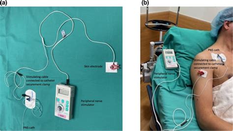 Peripheral Nerve Stimulation Through A ‘dry Peripheral Nerve Catheter