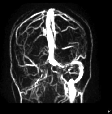 Bilateral Thalamic Bleed And Cerebral Venous Sinus Thrombosis In Japanese Encephalitis Bmj