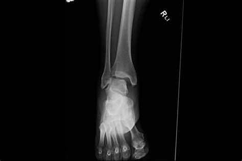 Ortho Dx Ankle Pain Following An Injury Clinical Advisor