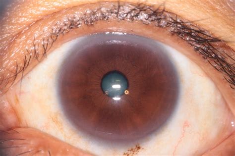 Sclerology Eye Chart Maikong Iridology Cameras And Iriscope Leading