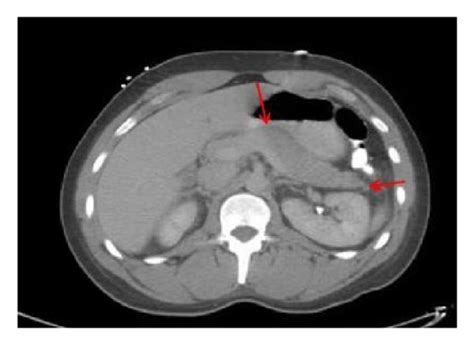 Ct Of The Abdomen With Contrast Showing Swollen Pancreas And