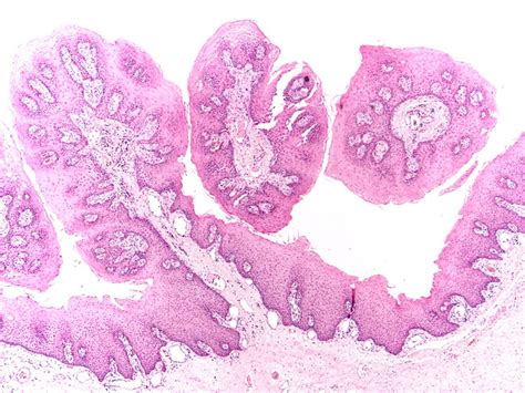 Esophageal Papillomatosis Pathology Squamous Papilloma Larynx The Best Porn Website